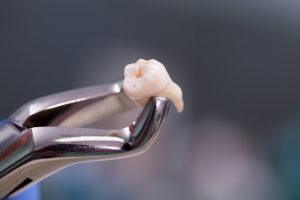 Wisdom Teeth Extraction