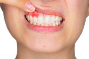 Early Treatment for Gum Disease