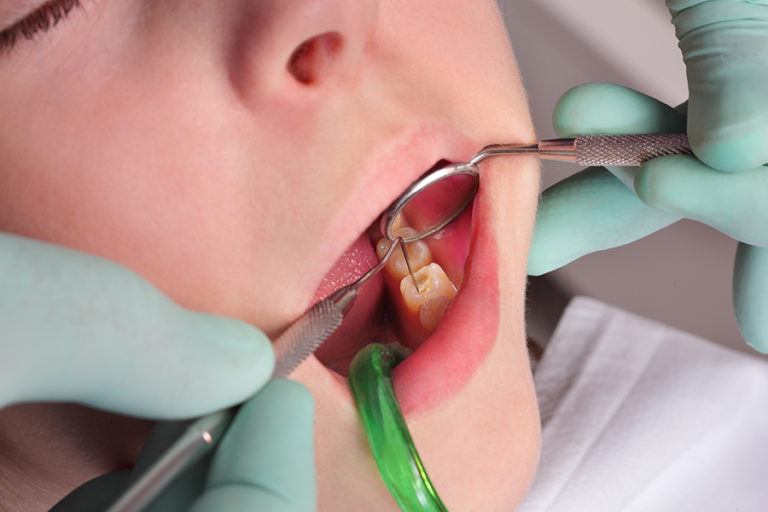 Mitos y verdades sobre la caries