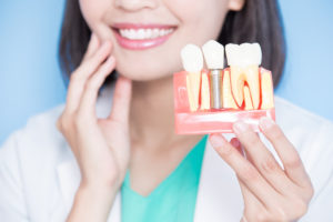 Dental Implants Permanent Restoration for Missing Teeth