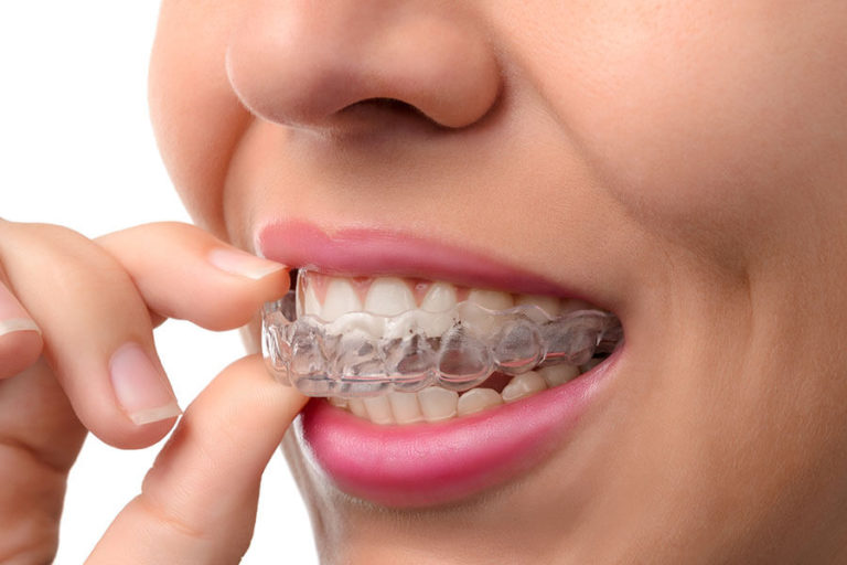 Are You a Good Candidate for Invisalign?