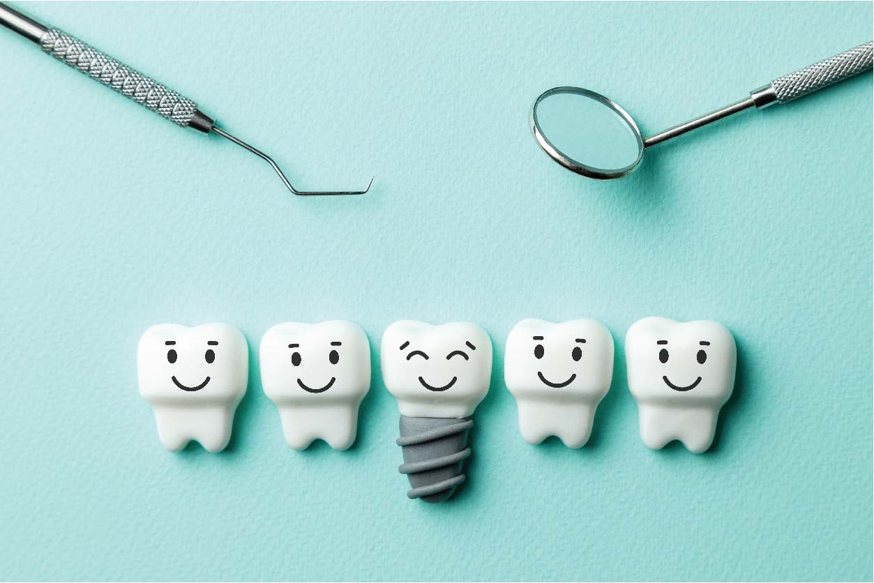 Dental implants as a premium tooth replacement solution