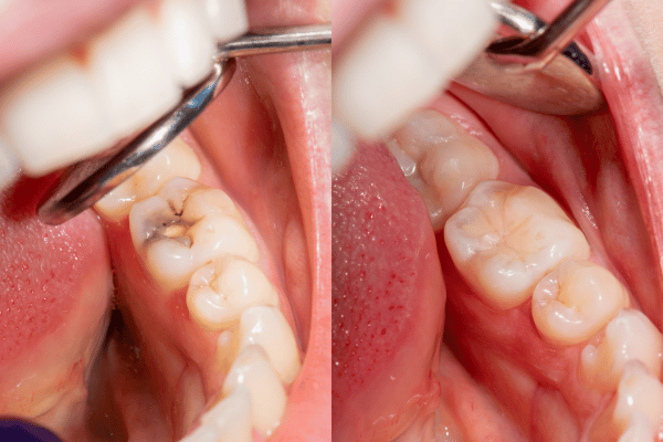 Exploring Dental Sealants What You Need to Know