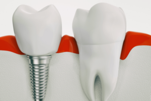 Exploring the Healing Timeframe for Dental Implant Recovery