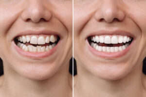 myDentalTX.com - Is It Possible to Get Veneers with Crooked Teeth