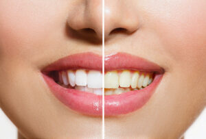 How to Fix Discolored Teeth