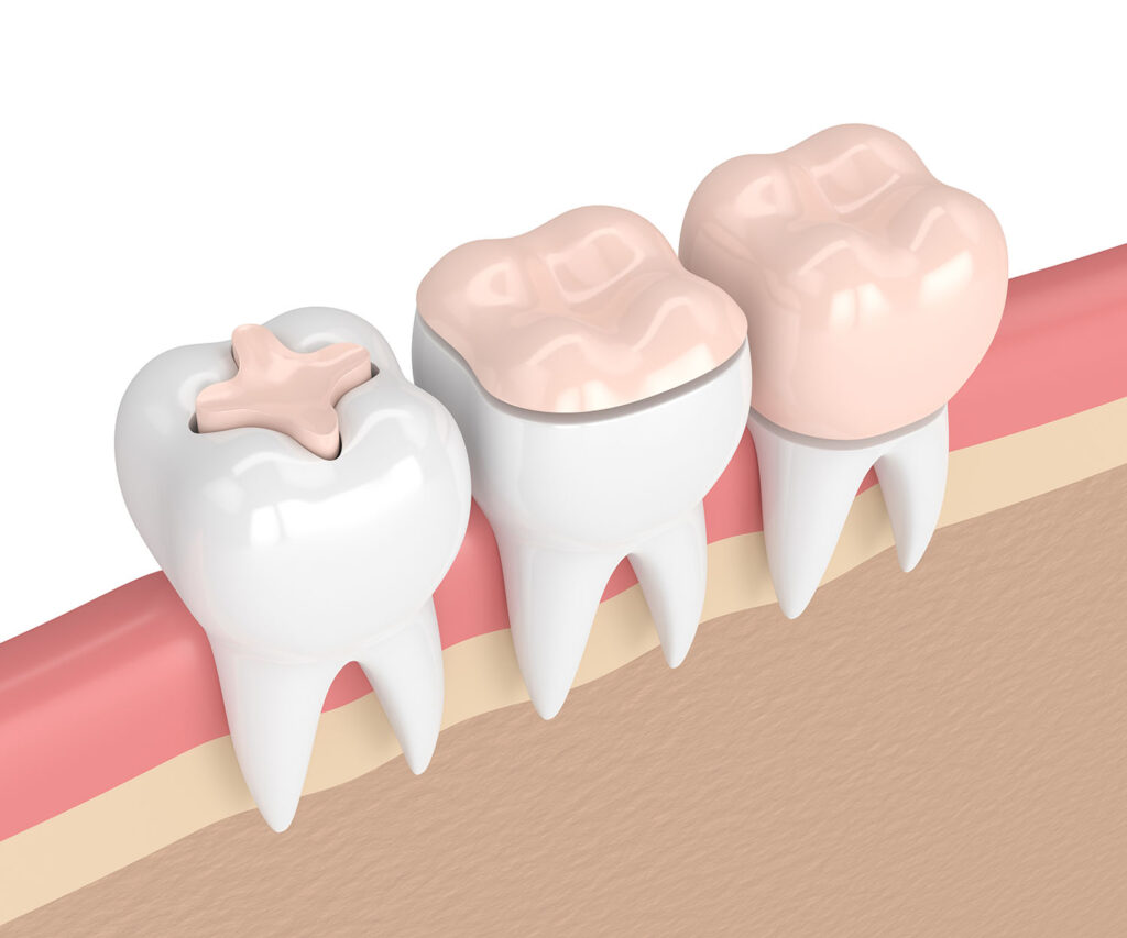 myDentalTX.com - Inlay or Onlay - Choosing the Best Option for You