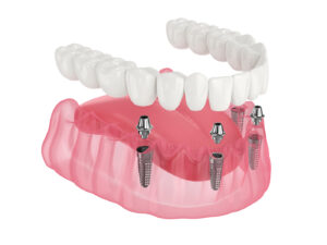 Traditional Implants vs All-on-4 Dental Implants: Key Differences