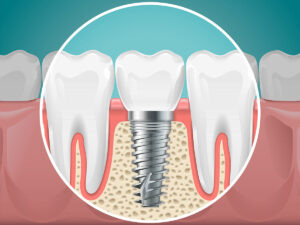 Resultados inmediatos: El poder de los implantes dentales en el mismo día