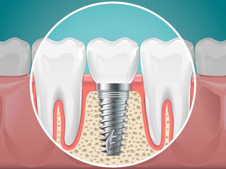 Experience Immediate Results: The Power of Same Day Dental Implants
