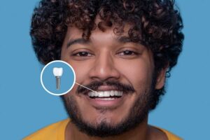 Ensure Longevity with Post Dental Implant Care Best Practices