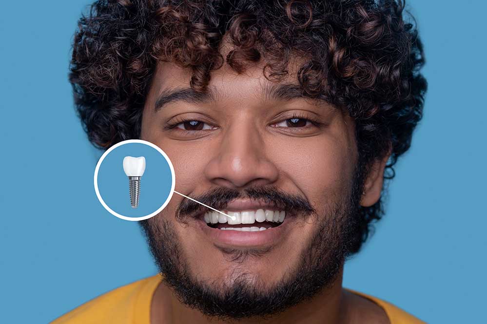 Garantice la longevidad con las mejores prácticas de cuidado postimplante dental