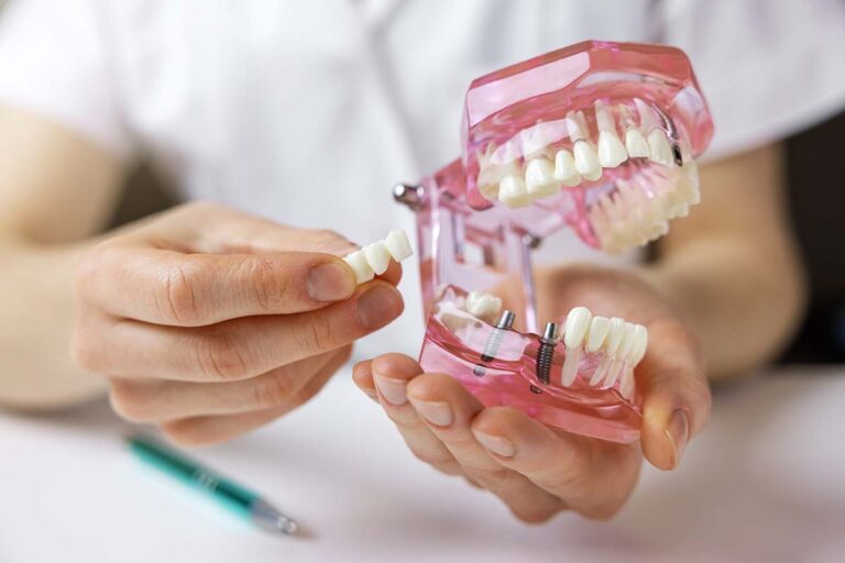Dental Implants: The Premium Solution for Replacing Missing Teeth