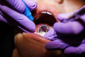 The Best Whole Mouth Restoration Options for a Healthier, Happier You