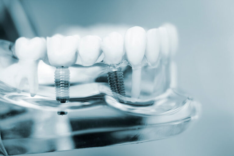 Señales de un implante dental fallido: qué tener en cuenta