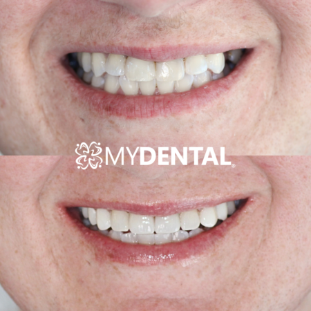 Patient smile transformation at myDental