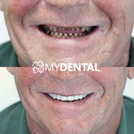 Patient smile transformation at myDental