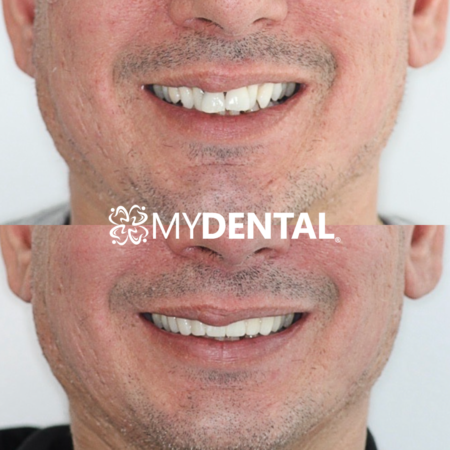 Patient smile transformation at myDental