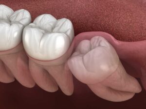 What Is the Real Cost of Wisdom Teeth Removal Without Insurance?