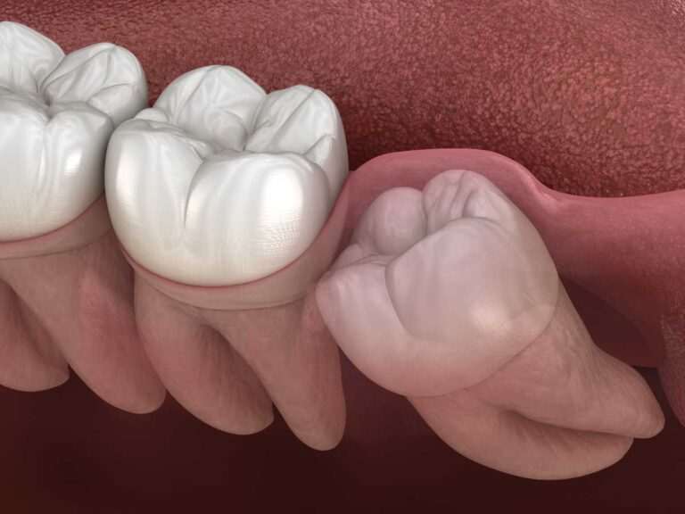 What Is the Real Cost of Wisdom Teeth Removal Without Insurance?