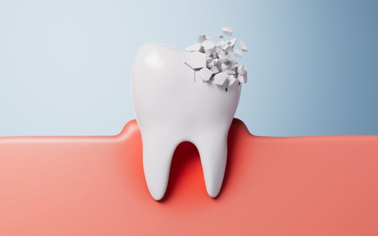 Chipped Tooth: What to Do Now and How a Dentist Fixes It