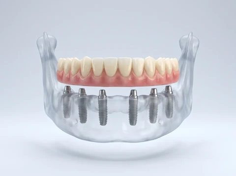 3D model of a lower jaw with six implants holding one fixed full-arch bridge