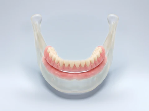 3D model of a lower jaw with a removable full denture resting on the gum ridge