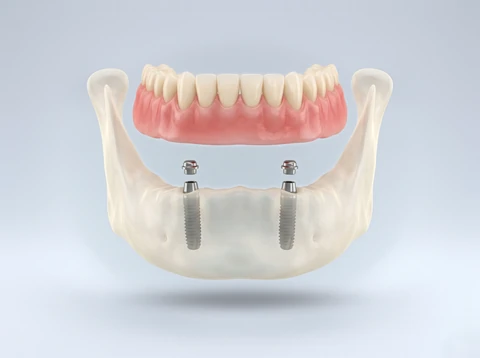 3D model of a lower jaw with two implants and snap attachments, a removable denture shown just above them