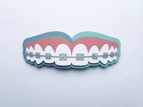 Traditional metal braces on patient teeth during orthodontic checkup
