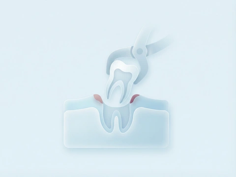 Illustration of an emergency tooth extraction showing a molar being removed from the jawbone