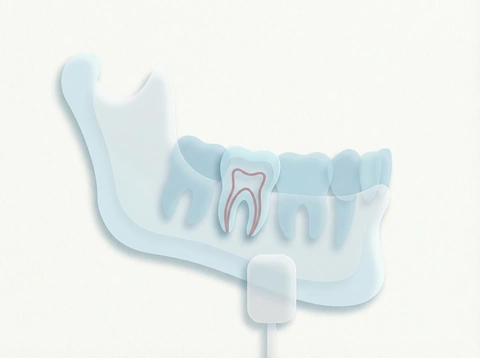Digital dental X-ray image showing teeth and jawbone