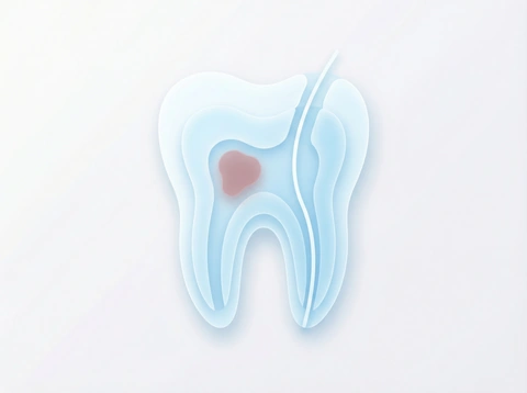 Standard root canal therapy procedure illustration